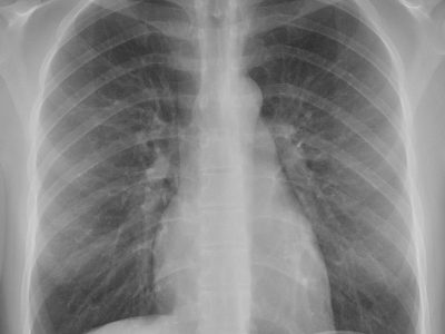 Normal_posteroanterior_(PA)_chest_radiograph_(X-ray)